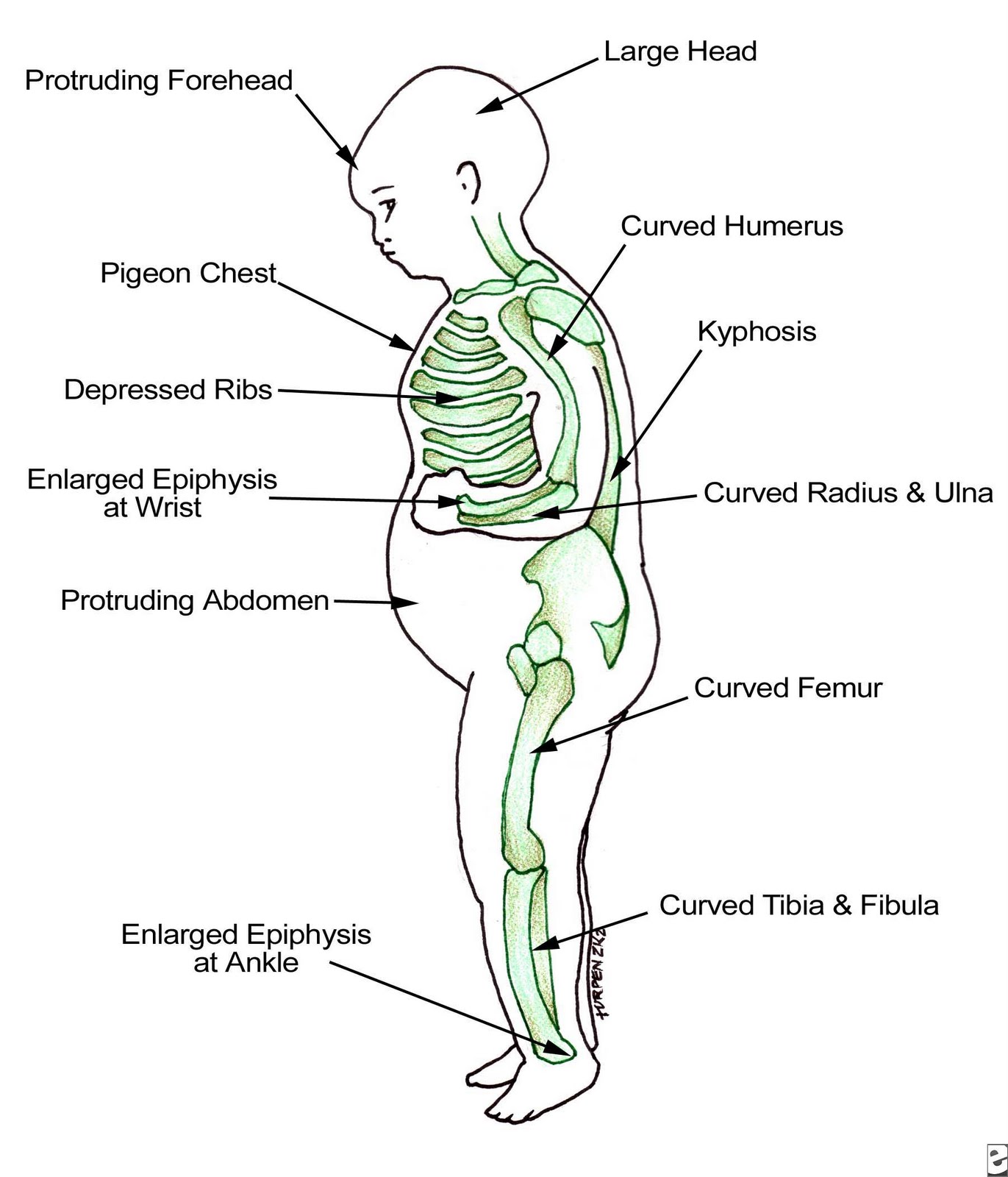 Rickets overview   mayo clinic